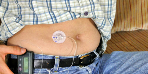 Insulin Pumps for Type 1 Diabetes – Types and Benefits