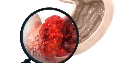 Ripretinib and Ayvakit: Advancing the Treatment of GIST Stomach Cancer