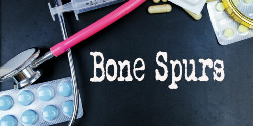 Bone Spurs – Causes, Types, and Management Options