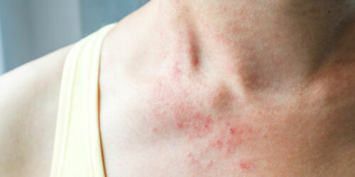 Mycosis fungoides – more than just a skin rash