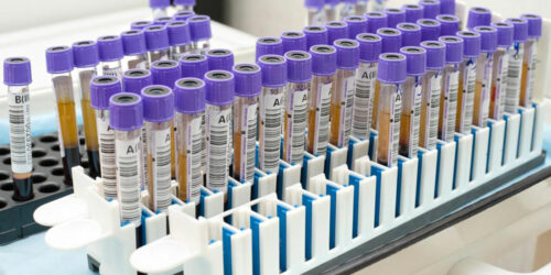 Here’s what you must know about age-specific PSA levels