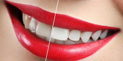 Yellow Teeth – How to avoid discoloration of teeth