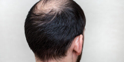 Male hair loss and its various aspects