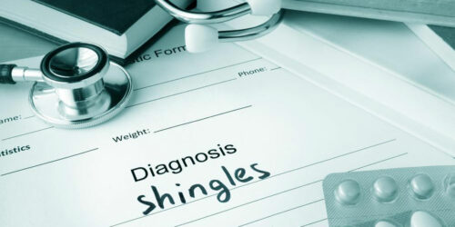 Natural Remedies for Shingles