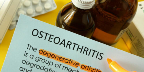 Osteoarthritis – How to Treat it