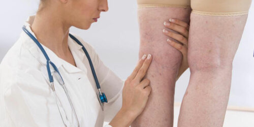 Effective Treatment for Varicose Veins
