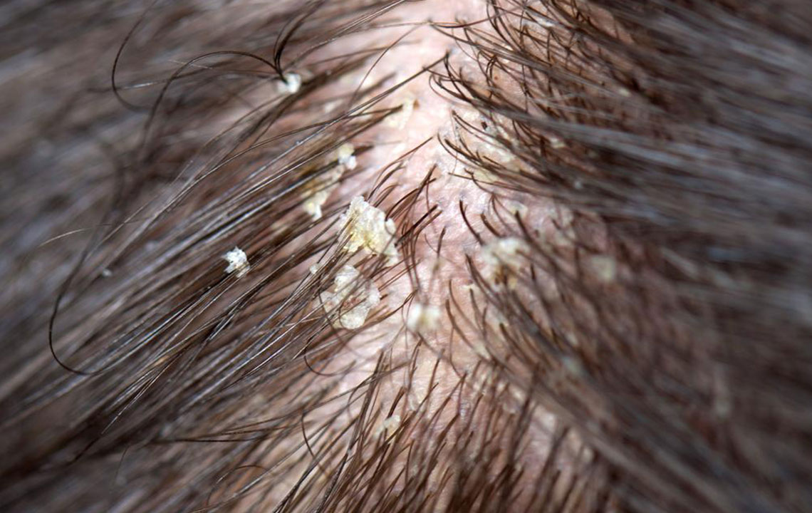 Get Rid of Dry Scalp with Nature’s Care