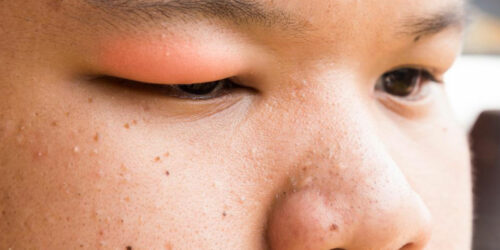 Here’s How to Get Rid of a Stye With These Simple Steps