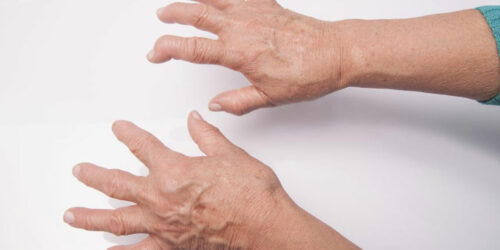 Here’s What You Need to Know About Rheumatoid Arthritis Symptoms