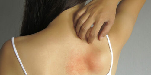 Here’s what you should know about allergies and how to treat them