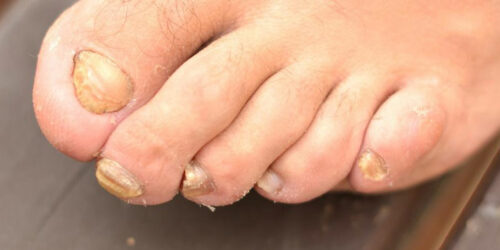 Toenail Fungus – Causes, Symptoms and Treatment