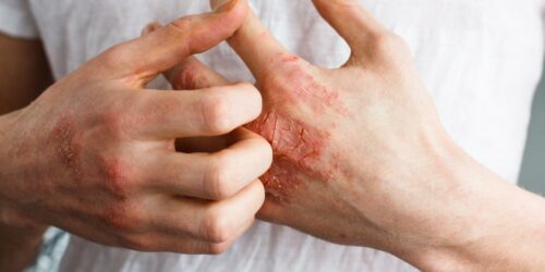 Treatment methods for eczema