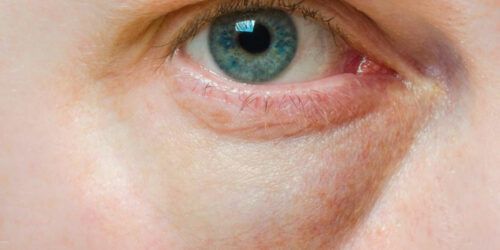 Treatment for eye conditions