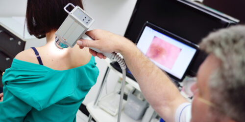 4 Commonly Asked Questions About Skin Keratosis