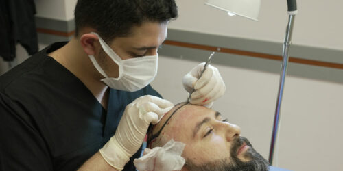 Everything to Know About a Hair Transplant in Turkey